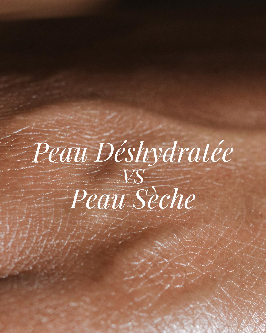 Peau sèche ou déshydratée : Comment faire la différence accentuée par l’hiver ?